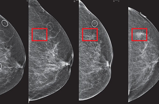 Photo of breast cancer screening